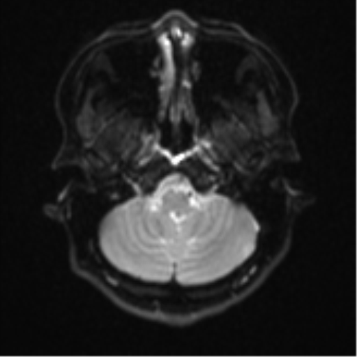 Cerebral cavernous venous malformations (Radiopaedia 48117-52946 Axial DWI 4).png