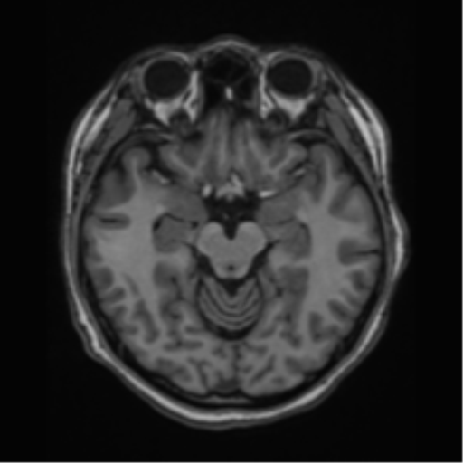 File:Cerebral cavernous venous malformations (Radiopaedia 48117-52946 Axial T1 11).png