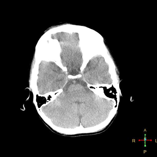 File:Cerebral contusion (Radiopaedia 48869-53911 Axial non-contrast 4).jpg