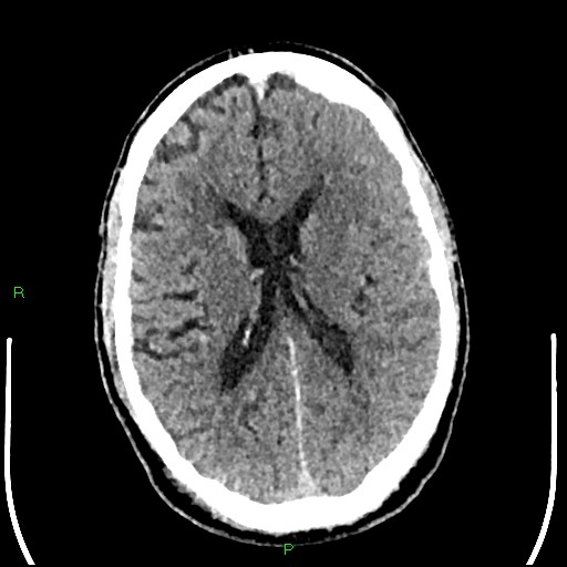 Cerebral contusions (Radiopaedia 33868-35039 Axial non-contrast 125).jpg