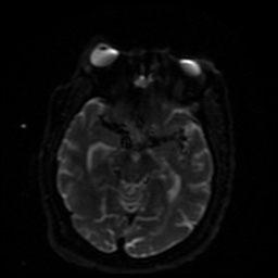 Cerebral embolic infarcts (embolic shower) (Radiopaedia 49837-55108 Axial DWI 29).jpg