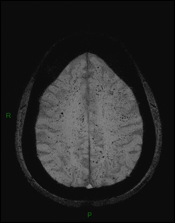 File:Cerebral fat embolism (Radiopaedia 35022-36525 Axial SWI 42).jpg