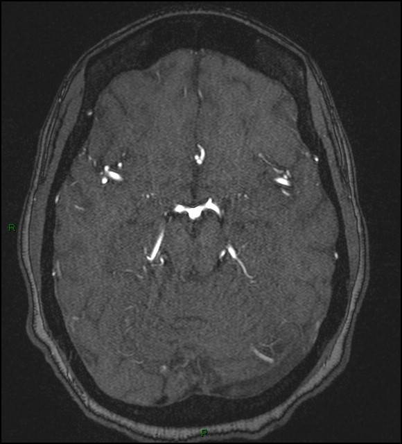 Cerebral fat embolism (Radiopaedia 35022-36525 Axial TOF 79).jpg