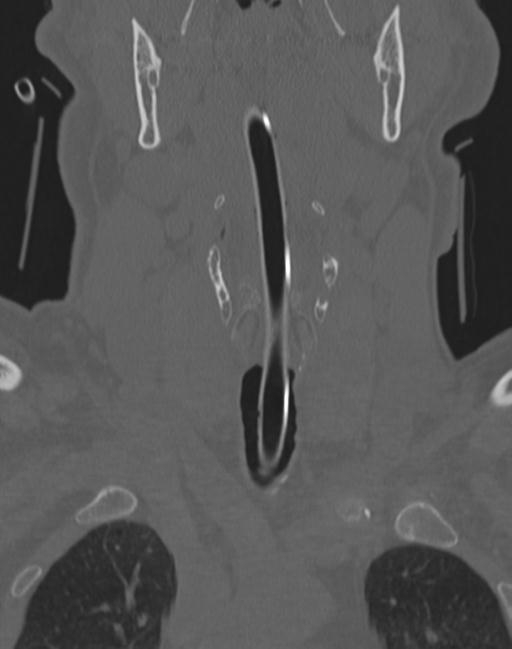 Cerebral hemorrhagic contusions and cervical spine fractures (Radiopaedia 32865-33841 Coronal bone window 8).jpg