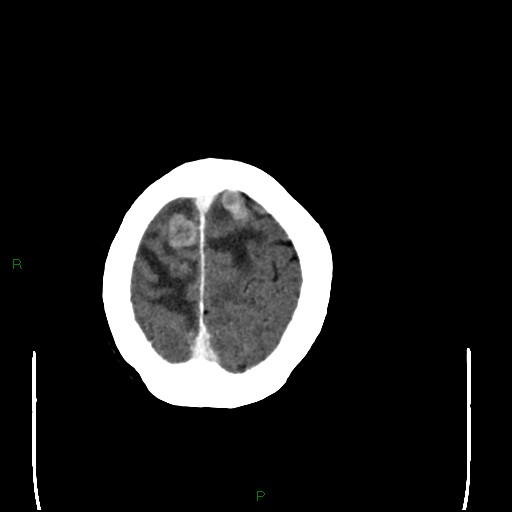 Cerebral metastases - breast primary (Radiopaedia 77653-89857 Axial C+ delayed 103).jpg