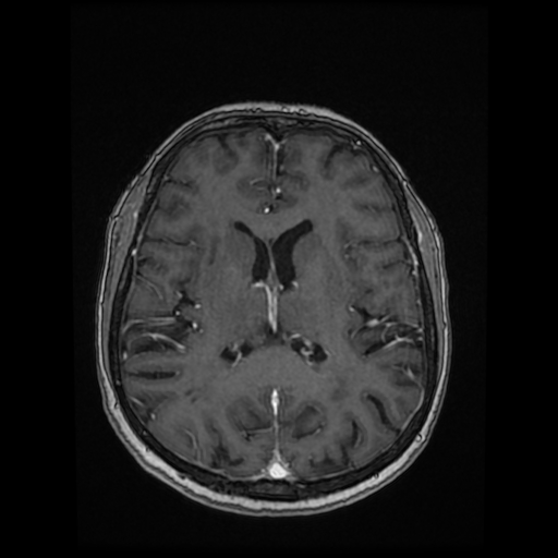 File:Cerebral metastases - melanoma (Radiopaedia 80972-94522 Axial T1 C+ 59).jpg