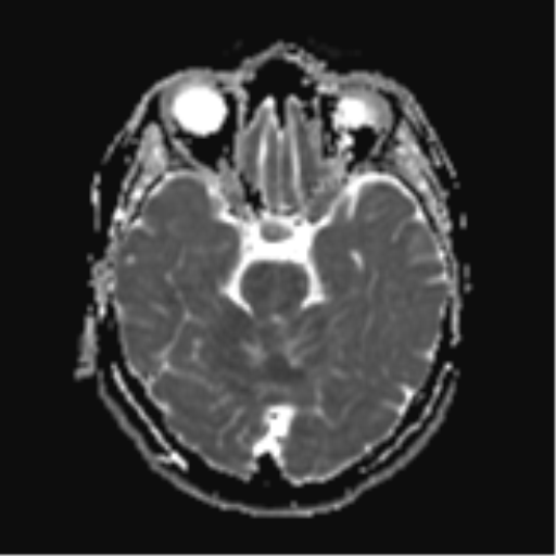 File:Cerebral metastases mimicking abscesses (Radiopaedia 45841-50131 Axial ADC 11).png