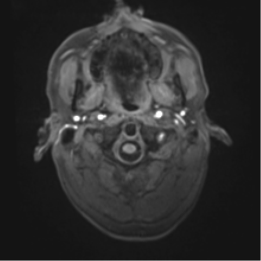 Cerebral metastasis - melanoma (Radiopaedia 54718-60954 Axial T1 2).png