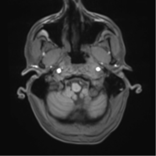 Cerebral metastasis - melanoma (Radiopaedia 54718-60954 Axial T1 8).png