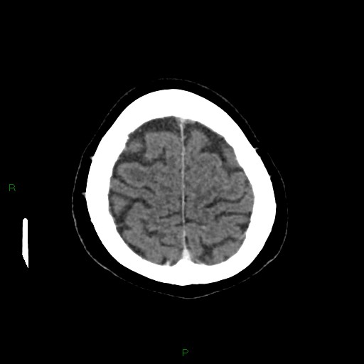 File:Cerebral metastasis from renal cell carcinoma (Radiopaedia 82306-96375 Axial C+ delayed 34).jpg