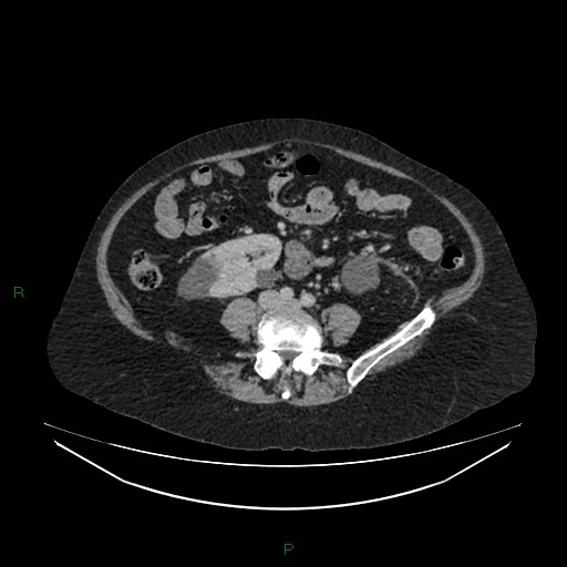 File:Cerebral metastasis from renal cell carcinoma (Radiopaedia 82306-96378 A 113).jpg