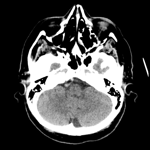 Cerebral metastasis to basal ganglia (Radiopaedia 81568-95412 Axial C+ delayed 16).png