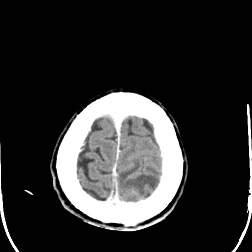 File:Cerebral toxoplasmosis (Radiopaedia 43956-47460 Axial C+ delayed 40).jpg