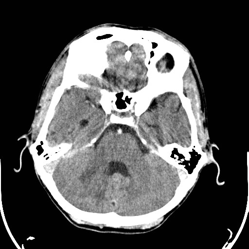 File:Cerebral toxoplasmosis (Radiopaedia 43956-47460 Axial C+ delayed 8).jpg
