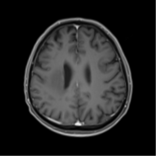 Cerebral toxoplasmosis (Radiopaedia 54575-60804 Axial T1 C+ 38).png