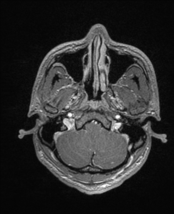 Cerebral toxoplasmosis (Radiopaedia 85779-101597 Axial T1 C+ 27).jpg
