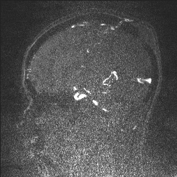 Cerebral tuberculosis with dural sinus invasion (Radiopaedia 60353-68090 Sagittal MRV 67).jpg
