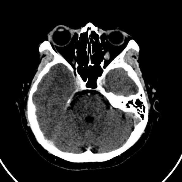 File:Cerebral venous hemorrhagic infarct from venous sinus thrombosis (Radiopaedia 55433-61883 Axial C+ delayed 106).jpg