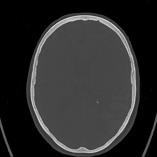 Cerebral venous infarction with hemorrhage (Radiopaedia 65343-74381 Axial bone window 104).jpg