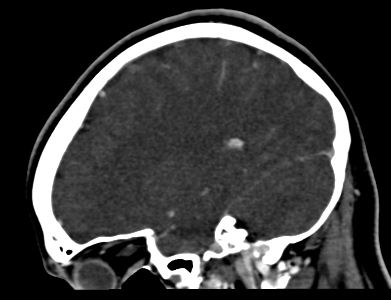 Cerebral venous sinus thrombosis (Radiopaedia 59224-66646 Sagittal C+ delayed 8).jpg