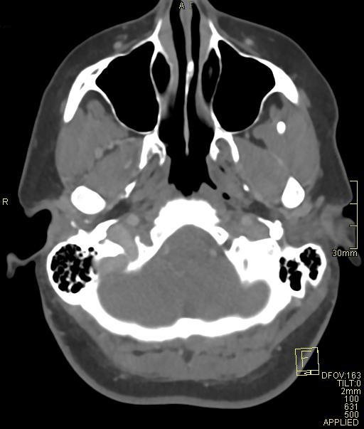 Cerebral venous sinus thrombosis (Radiopaedia 91329-108965 Axial venogram 14).jpg