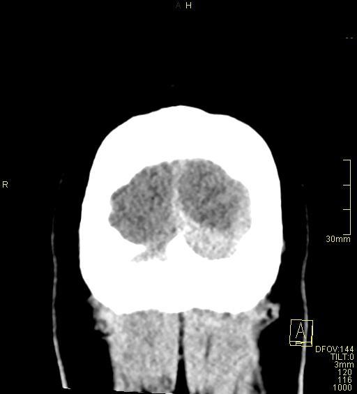 File:Cerebral venous sinus thrombosis (Radiopaedia 91329-108965 Coronal non-contrast 54).jpg