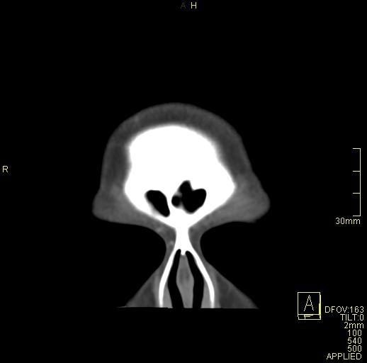 Cerebral venous sinus thrombosis (Radiopaedia 91329-108965 Coronal venogram 6).jpg