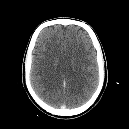 File:Cerebral venous thrombosis (CVT) (Radiopaedia 77524-89685 Axial non-contrast 30).jpg