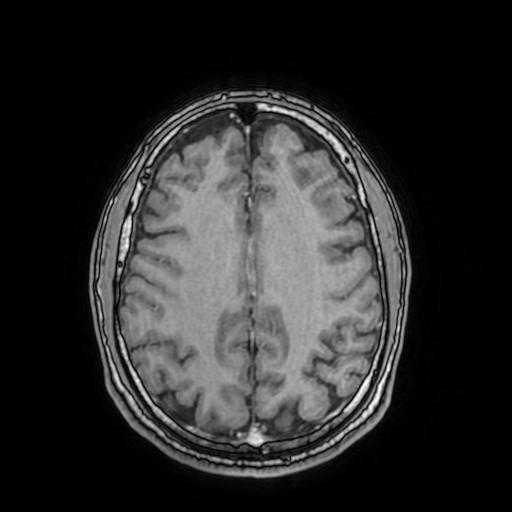 File:Cerebral venous thrombosis with secondary intracranial hypertension (Radiopaedia 89842-106957 Axial T1 C+ 120).jpg