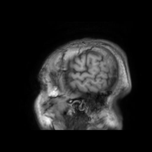 File:Cerebral venous thrombosis with secondary intracranial hypertension (Radiopaedia 89842-106957 Sagittal T1 4).jpg