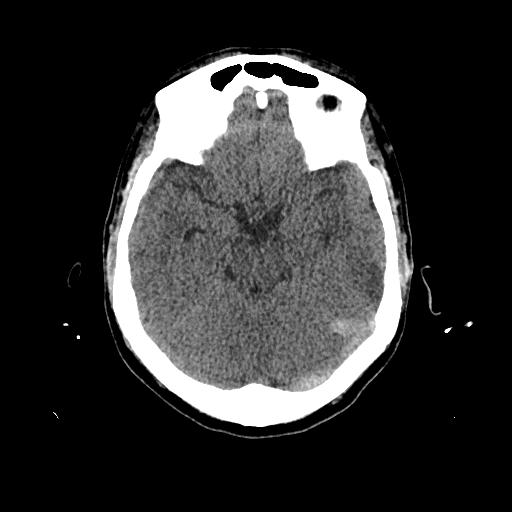 File:Cerebral venous thrombosis with venous hemorrhagic infarct (Radiopaedia 90354-107660 Axial non-contrast 19).jpg