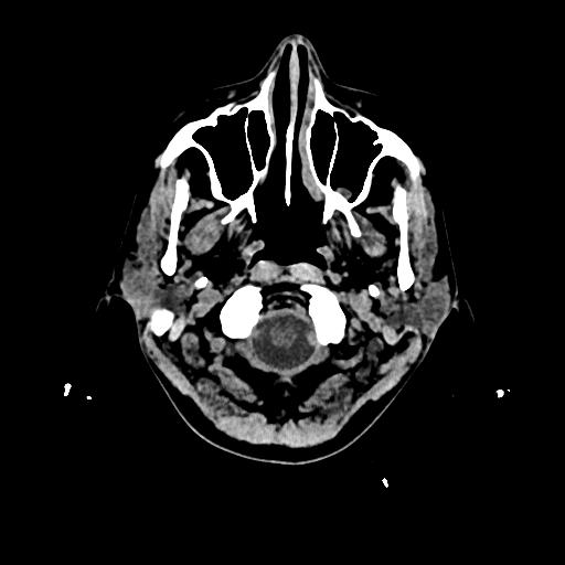 File:Cerebral venous thrombosis with venous hemorrhagic infarct (Radiopaedia 90354-107660 Axial non-contrast 3).jpg