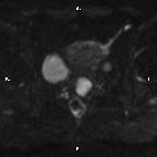 Cervical adenocarcinoma (Radiopaedia 65011-73985 Axial DWI 41).jpg