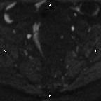 Cervical adenocarcinoma (Radiopaedia 65011-73985 Axial DWI 74).jpg