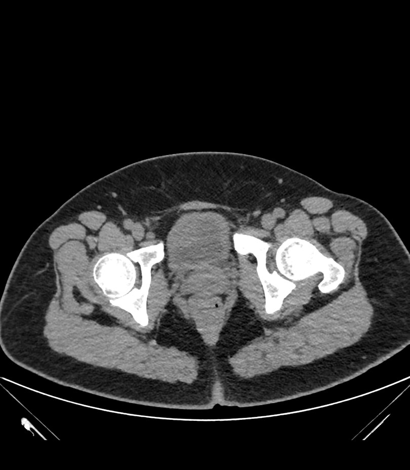 Cervical aortic arch with coarctation and aneurysms (Radiopaedia 44035-47552 Axial non-contrast 96).jpg