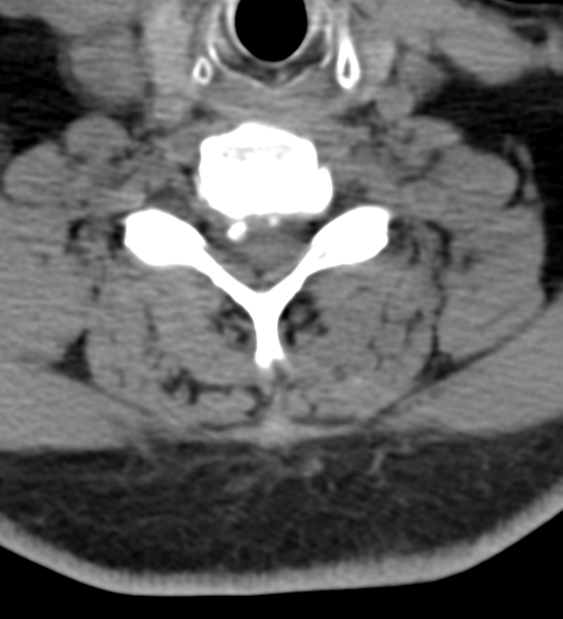 Cervical canal stenosis due to ossification of the posterior longitudinal ligament (Radiopaedia 47260-51823 Axial non-contrast 43).png