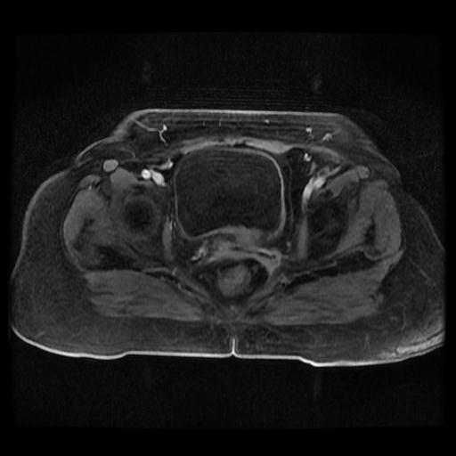 Cervical carcinoma (Radiopaedia 70924-81132 Axial T1 C+ fat sat 222).jpg