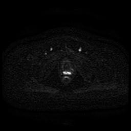 Cervical carcinoma (Radiopaedia 85405-101028 Axial DWI 24).jpg