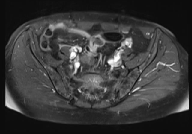 File:Cervical carcinoma (Radiopaedia 88312-104943 Axial T1 C+ fat sat 7).jpg