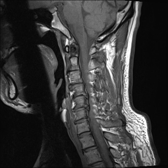 File:Cervical disc extrusion (Radiopaedia 53950-60077 Sagittal T1 11).jpg