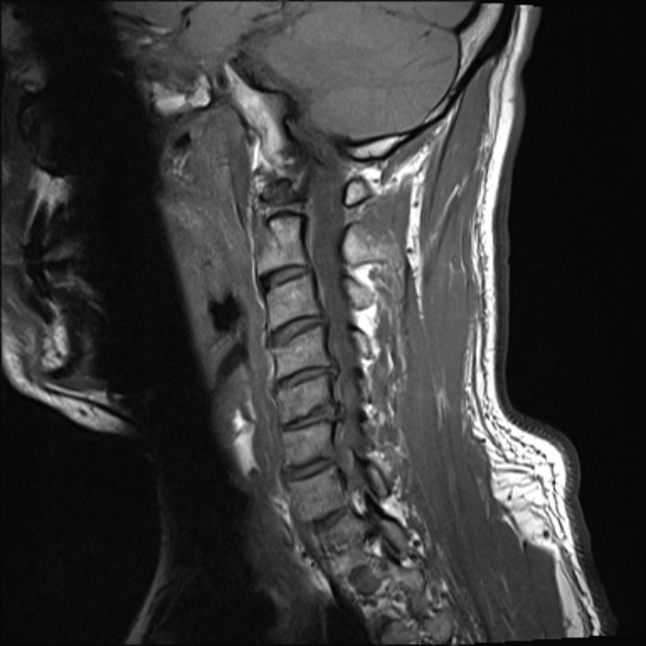 File:Cervical disc extrusion (Radiopaedia 53950-60077 Sagittal T1 7).jpg