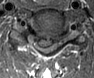 File:Cervical disc herniation with spinal cord compression (Radiopaedia 14353-14266 B 1).jpg
