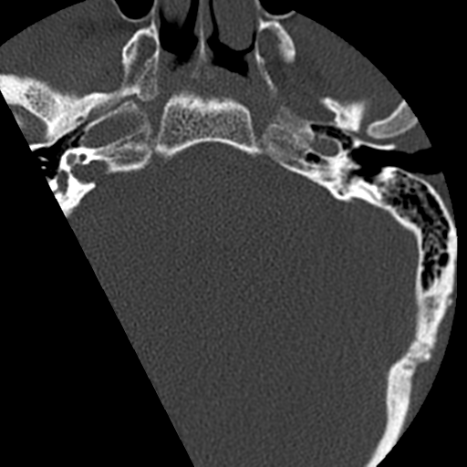 File:Cervical schwannoma (Radiopaedia 57979-64974 Axial bone window 3).png
