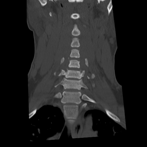 Cervical schwannoma (Radiopaedia 57979-64974 Coronal bone window 24).png