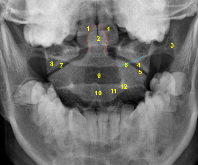 File:Cervical spine- open mouth annotated view (Radiopaedia 80169).jpg