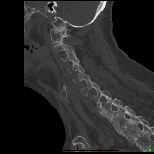 Cervical spine fracture - ankylosing spondylitis (Radiopaedia 76835-88706 Sagittal bone window 39).jpg