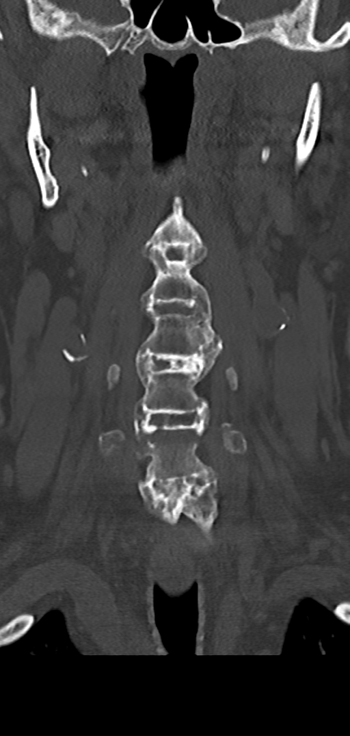 Cervical spine fracture - chalk stick (Radiopaedia 39116-41323 Coronal bone window 14).png