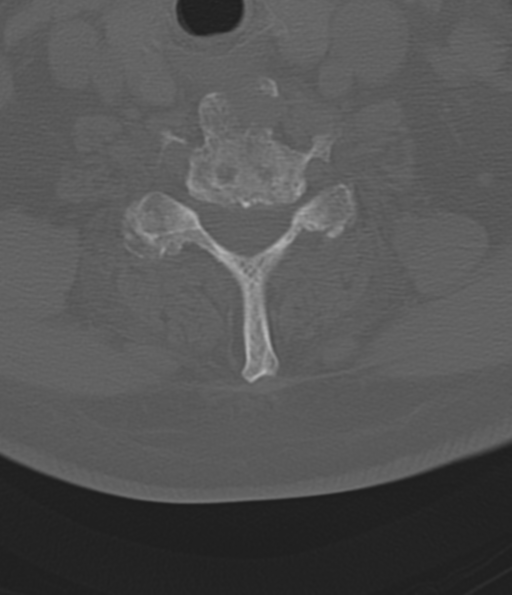 Cervical spine fracture in the setting of ankylosis (Radiopaedia 37038-38715 Axial bone window 43).png