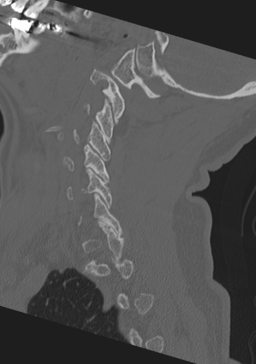 Cervical spine fractures with vertebral artery dissection (Radiopaedia 53296-59268 Sagittal bone window 48).png