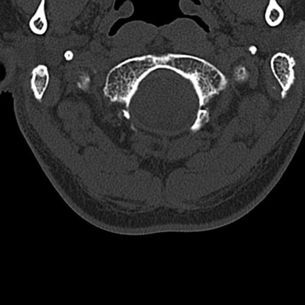 Cervical spondylodiscitis (Radiopaedia 28057-29489 Axial bone window 13).jpg
